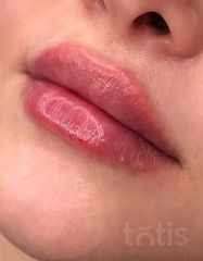 Результати Saypha Filler Lidocaine NEW  фото после #2