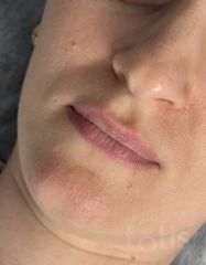 Результати Saypha lips Lidocaine  фото до #1