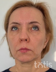 Rezultaty Zestaw TESSLIFT SOFT V-DERM (10 nici) + Bandaż + kaniula SoftFil 18G 70mm + igła 18G  фото до #1