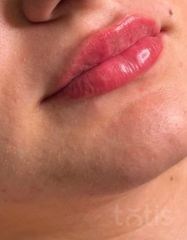 Результати Saypha Filler Lidocaine NEW  фото после #2
