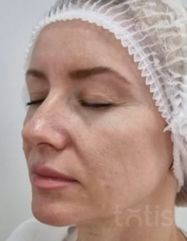 Результати Facetem S 1,5 ml  фото до #1