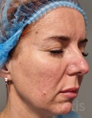 Rezultate Facetem S 0.8ml * 1 seringă  фото до #1